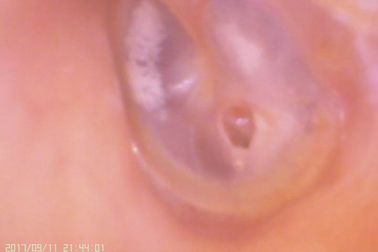 Video Telinga Dan Hidung C Digital Otoscope Untuk Perforasi Membran Timpani
