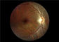 Fokus Otomatis Video Medis Ophthalmoscope Dengan FOV 45 °