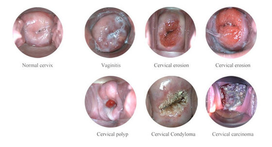 Colposcope Elektronik Digital Portable