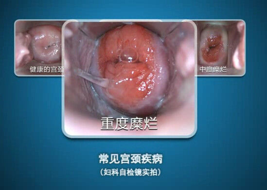 Digital Endoskopi Inspeksi-Sendiri Kolposkopi Mini Kolposkopi dengan Rentang Pengamatan 70 ~ 100mm