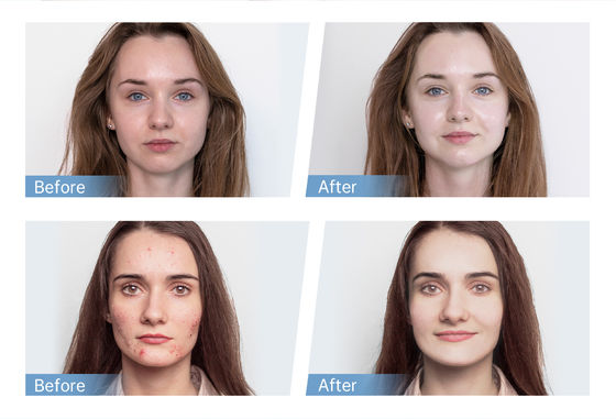 Terbaru 4-Pole EMS Automatcal Serum Applicator Hydra Pen H5 Wajah Kulit Derma Microneedling Pen Essence Kolagen Regenerasi