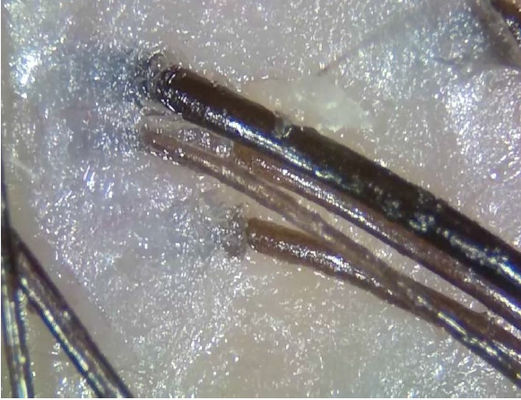 Alat Penganalisa Kulit Digital Nirkabel Portabel Telemedicine Diagnosis Dengan Cahaya Polarisasi