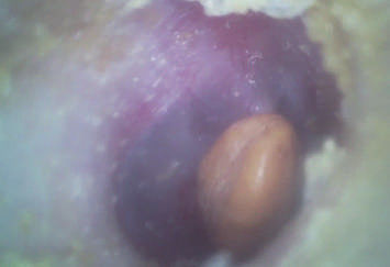 Portable THT Scope Economic Handheld Digital Video Otoscope Dengan Micro SD Flash Card 32G